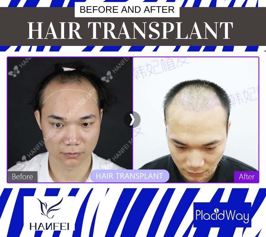 Patient Testimonial Hair Transplant in Guangzhou, China